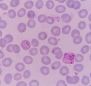 Malaria testing in Guyana